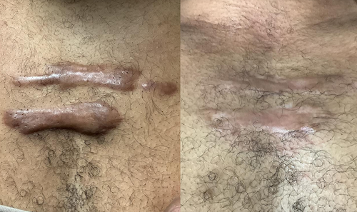 scar removal before after mississauga oakville